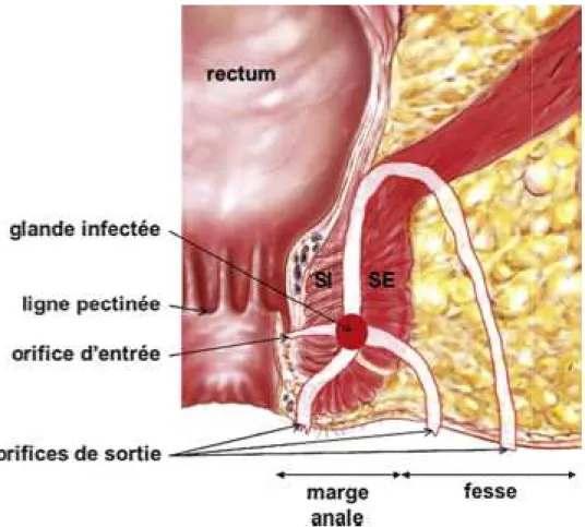 Fig. 7: Anatomie topographique simplifiée des fistules anales cryptoglandul SI : sphincter interne