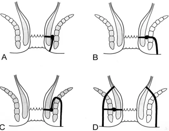 Fig. 12  A : Fistule inter-sphinctérienne. B : Fistule trans-sphinctérienne. C : Fistule supra-sphinctérienne