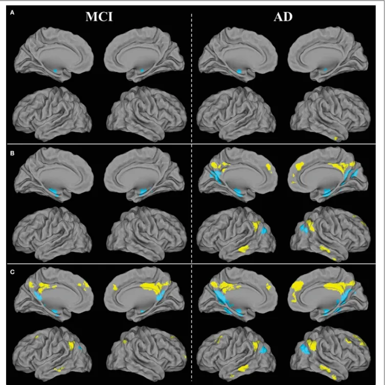 FIGURE 4 | Brain areas showing significant FC disruptions (A), atrophy (B), and hypometabolism (C) within the ventral (blue) and dorsal (yellow) PCC networks of patients with aMCI or AD compared with HE, as revealed by ANCOVAs thresholded at p (uncorrected