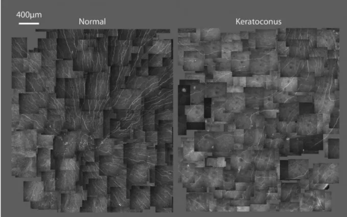 Figure  7 :  Plexus  nerveux  superficiel  de  la  cornée  désorganisé  dans  le  cas  du  Kératocône  (image de droite - microscopie confocale)