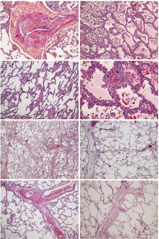 FIGURE 2 Lung samples of patients suffering from chronic thromboembolic pulmonary hypertension (CTEPH) (ineffective pulmonary endarterectomy group), stained with haematoxylin-eosin and haematoxylin-eosin-saffron.