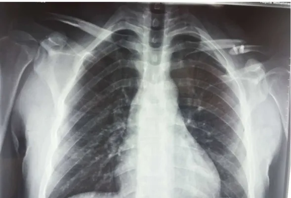 Figure 8    : Image radiographique de face d’une fracture type IIB1 selon la classification  d’Edinburgh