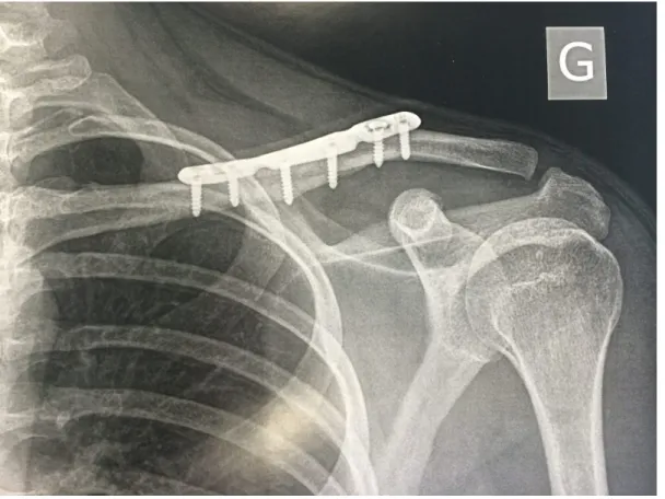 Figure 15    : Ostéosynthèse avec une plaque verrouillé en S d'une fracture de clavicule  