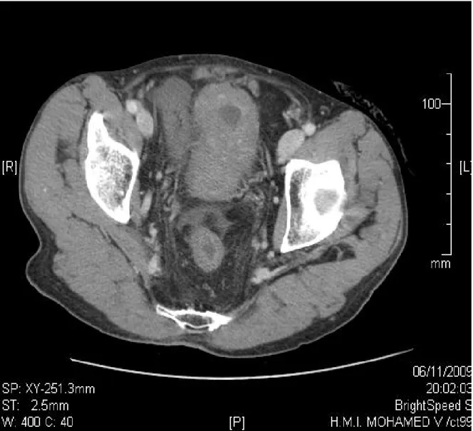 Figure 4 : Image de TDM abdominale montrant l’épaississement étendu du grêle  pelvien