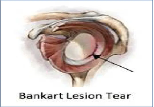 Figure 10: lesion de bankart 