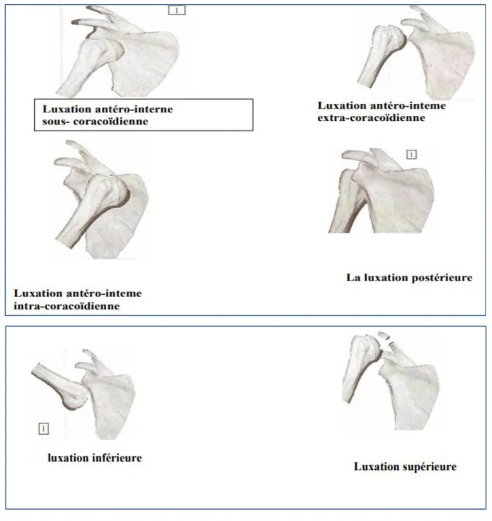 Figure 11: les différents types de luxations de l'épaule 