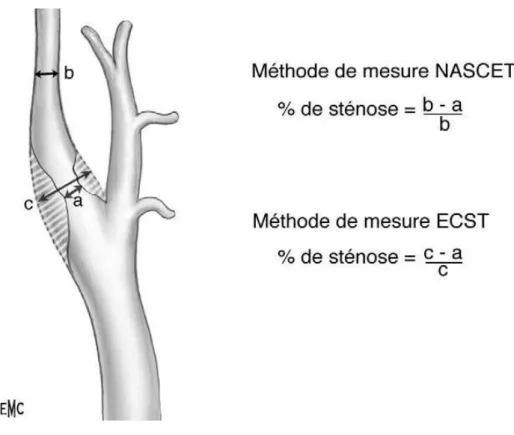 Figure 5 : Évaluation de degrés de sténoses d’après l’angiographie. NASCET :  North American Symptomatic Carotid Endarterectomy Trial ; ECST: European Carotid 