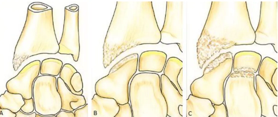 Figure n°1: Séquences d’apparition de l’arthrose (« SLAC wrist ») [1]. 