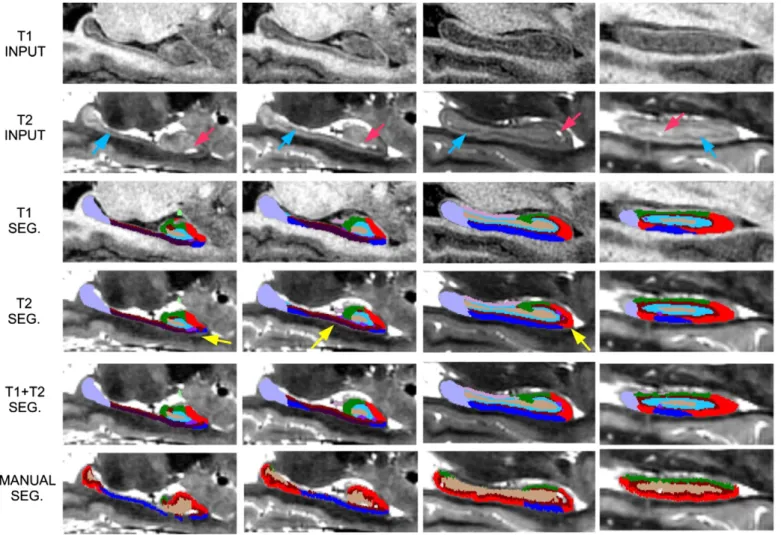 Fig. 10. 3D renderings of segmentations of the high-resolution T1/T2 data. (a) Manual seg- seg-mentation from Winterburn et al