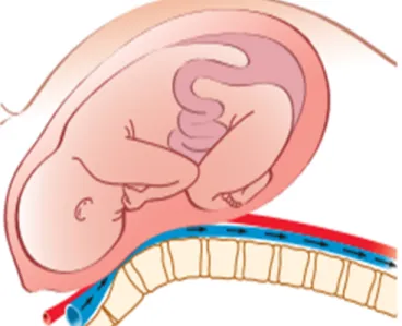 Figure 2.mécanisme du choc postural par compréssion de la veine cave par  l’utérus [7]