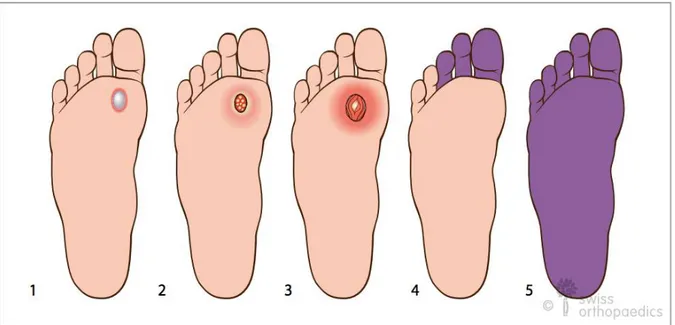 Figure  1: Classification du pied diabétique selon Wagner [8] 