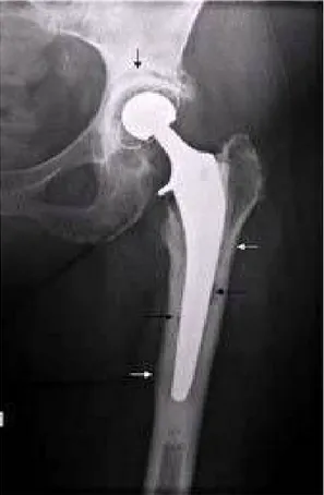 Figure 3: radiographie d'une géode et d'appositions périostés   sur une prothèse totale de la hanche infectée [17] 