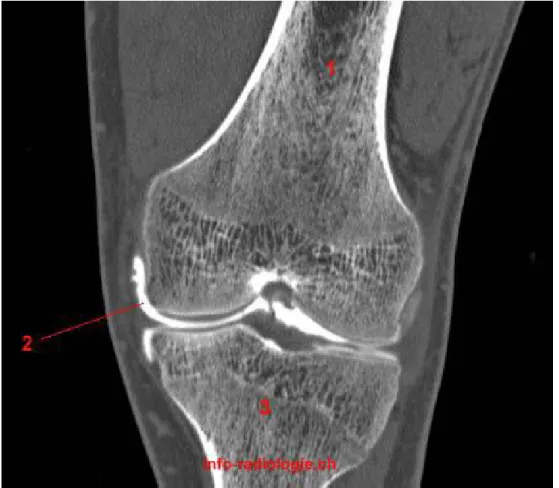 Figure 6 : scanner après arthrographie du genou [19] 
