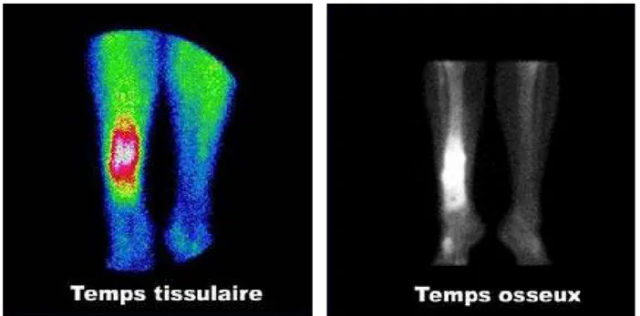 Figure 7: scintigraphie montrant une ostéite du tibia en deux temps. [20] 