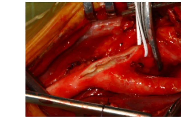 Figure 13 : artériotomie lors d’une endartériectomie carotidienne à ciel ouvert 
