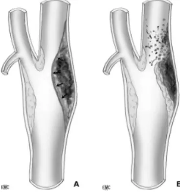 Figure 2 : complications anatomiques au niveau de la plaque: 37  A-hémorragie B-ulcération 