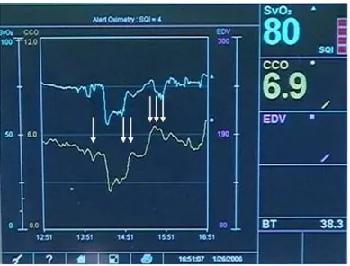 Figure 9 : Expérimentation d’un choc hémorragique chez le porc qui objective la chute de débit  cardiaque et de la SvO 2  après soustraction sanguine (1 flèche) puis la remontée des ces deux  paramètres après retransfusion