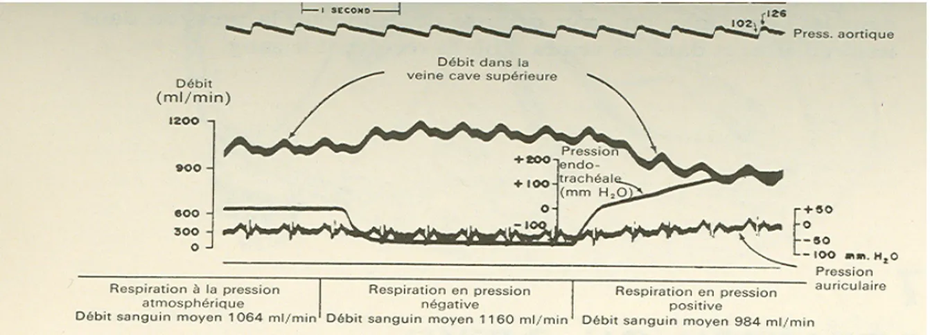 Figure 14 : Partie d'un enregistrement optique objectivant les modifications du débit de la veine cave  supérieure pour différentes pressions endotrachéales à thorax fermé
