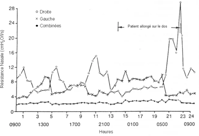 Figure 1-10 : Cycle nasal enregistré durant une période de 24 heures comprenant une activité normale et une  récupération avec sujet allongé sur le dos [Cole P et coll., 1986] 
