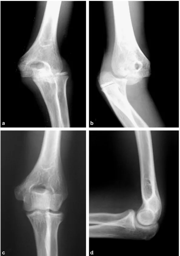Fig. 2. Fracture de l’épicondyle médial stade IV (a, b) traitée orthopédiquement   avec très bon résultat radiologique (c, d) et fonctionnel à six ans de recul