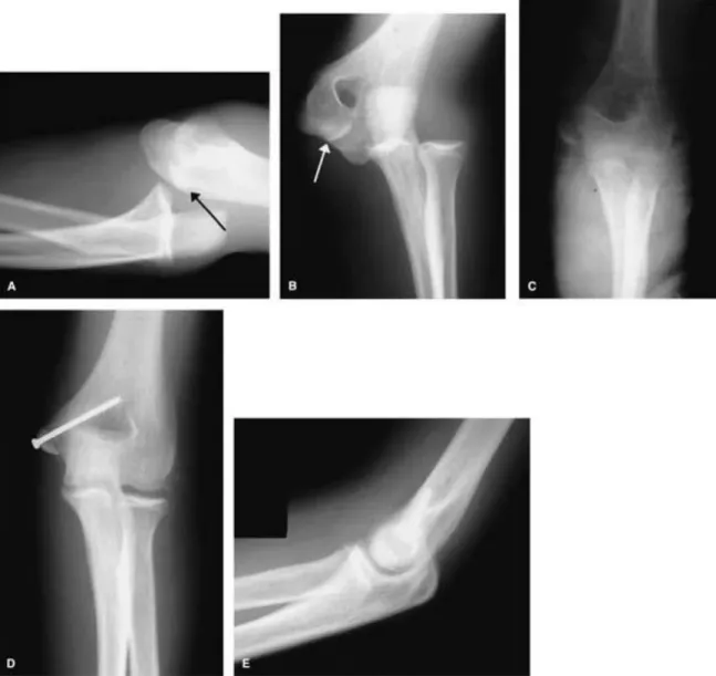 Fig. 4. Un garçon de 15 ans qui présente une fracture de   l’épicondyle médial avec luxation du coude