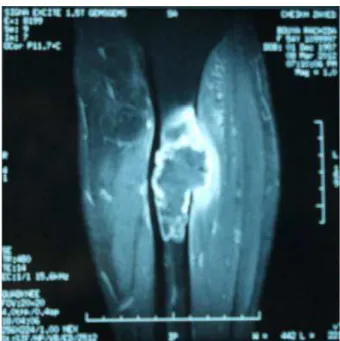Figure 2 : IRM  de la jambe gauche de la patiente (vue coronale) 
