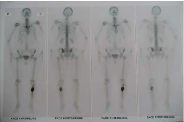 Figure 4 : Scintigraphie de la patiente 