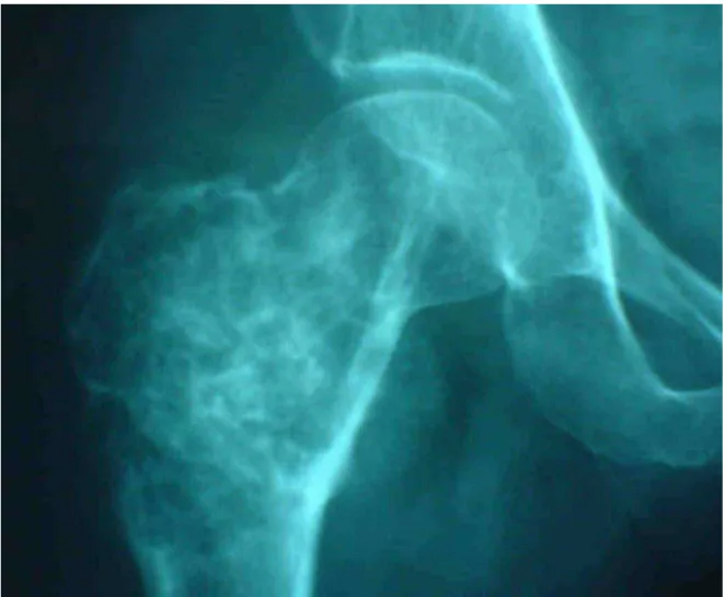 Figure 15 : radiographie de face de la hanche droite 