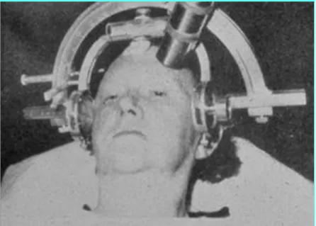 Figure 4 : Photo d’un patient traité par radiochirurgie en 1951 [18] pour névralgie  faciale avec le repérage du nerf avec cadre de LEKSELL et Irradiation par tube à 