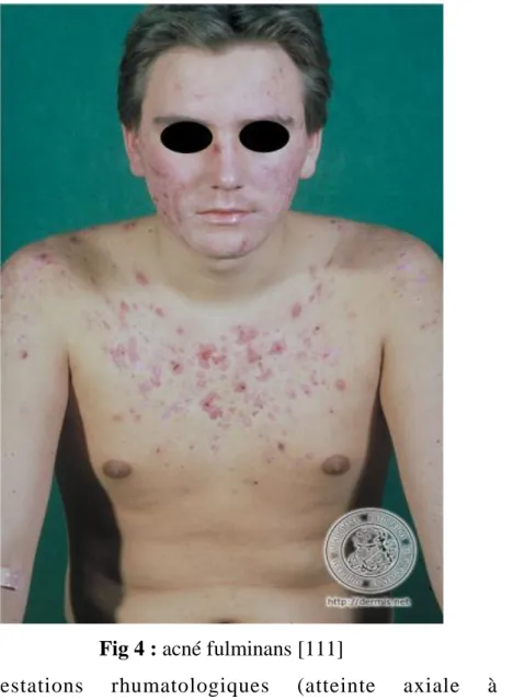 Fig 4 : acné fulminans [111] 