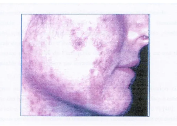 Fig. 13 : Effets irritant d’un traitement par isotrétinoine [   ]. 