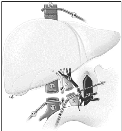 Fig 2 : Transplantation hépatique avec clampage cave total 