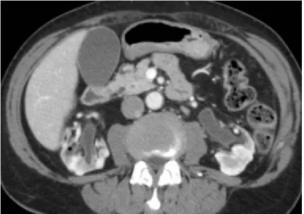 Figure 3  : syndrome obstructif urinaire bilatéral des reins natifs avec lithiase calicielle gauche