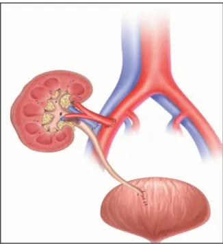 Figure 13 : Procédure chirurgicale standard de transplantation rénale 