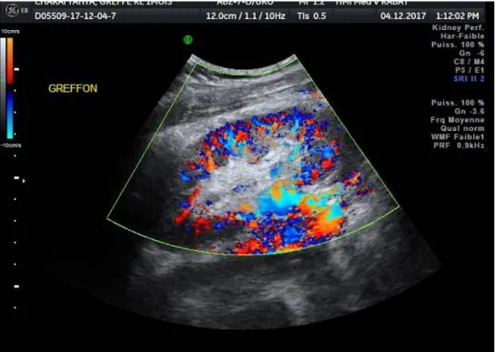 Figure 17: Spectre normal enregistré dans le tronc de l’artère rénal avec temps de montée 