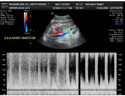 Figure 30 : Les tracés Doppler spectraux : montrent des vitesses systoliques maximales, et des  turbulences