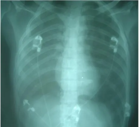 Figure 5a : aspect radiographique montrant une grisaille diffuse