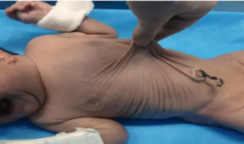 Figure 5 : nourrisson atteint de la maladie du cutis laxa 