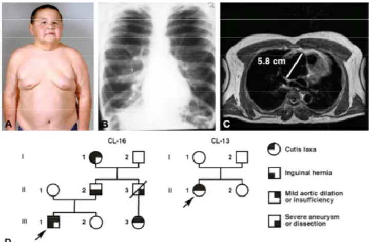 Figure 6 Manifestation et heredité du cutis laxa autosomal dominat A. photograph du  patient a 13ans B