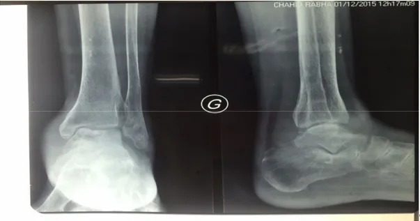 Figure 1 :  : radiographie conventionnelle de la cheville gauche  de face et de profil 