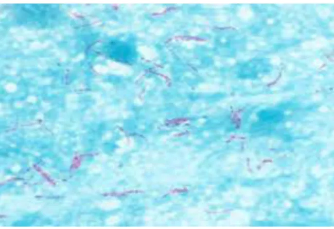 Figure 7 : Résultat de l’examen direct par coloration de Ziehl-Neelson 