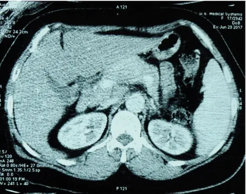 Figure 11 :  Image tomodensitométrique objectivant la tumeur pancréatique 