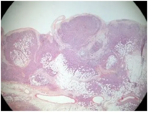 Fig 5 : cellules disposées en amas bien délimités. [ 29 ] 