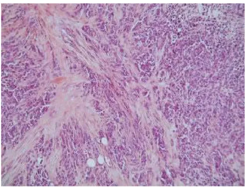 Fig 6 : Stroma cellulaire desmoplasique. [29] 