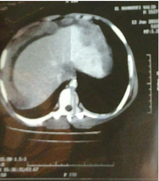 Figure 13 : interprétation : TDM en coupe horizontale :   Carcinose péritonéale et épanchement perihépatique