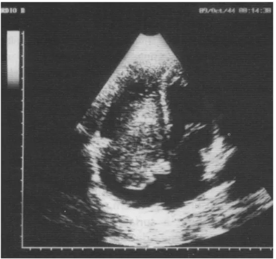 Fig. N°1 : Myxome enclavé dans la valve tricuspide. 