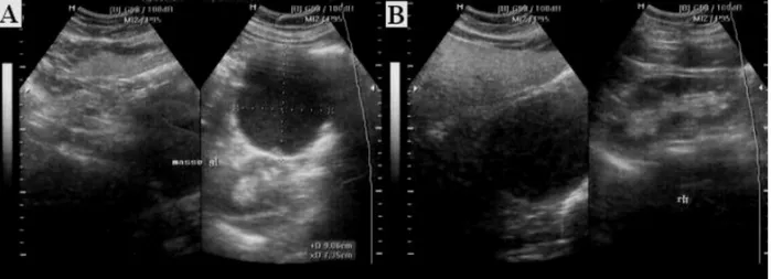 Figure 2 : Echographie abdominale montrant une formation liquidienne avec des  cloisons internes en regard du pôle supérieur du rein gauche