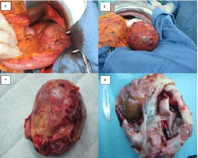 Figure 7 : (A et B ) Images peropératoires montrant une tumeur encapsulée bien limitée