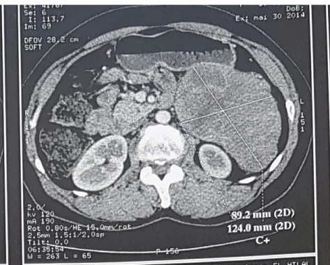 Figure 9 : coupe tomodensitométrique montrant une masse tissulaire de l’hypochondre  gauche qui mesurait environ 124 *90 mm sur ses grands axes