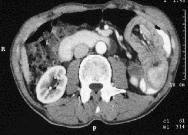 Figure 4: TDM abdominale : image du boudin d’invagination jéjunale. 